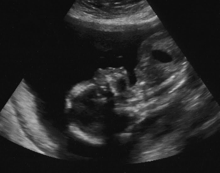 nude brother and sister together how accurate is ultrasound dating at 12 weeks